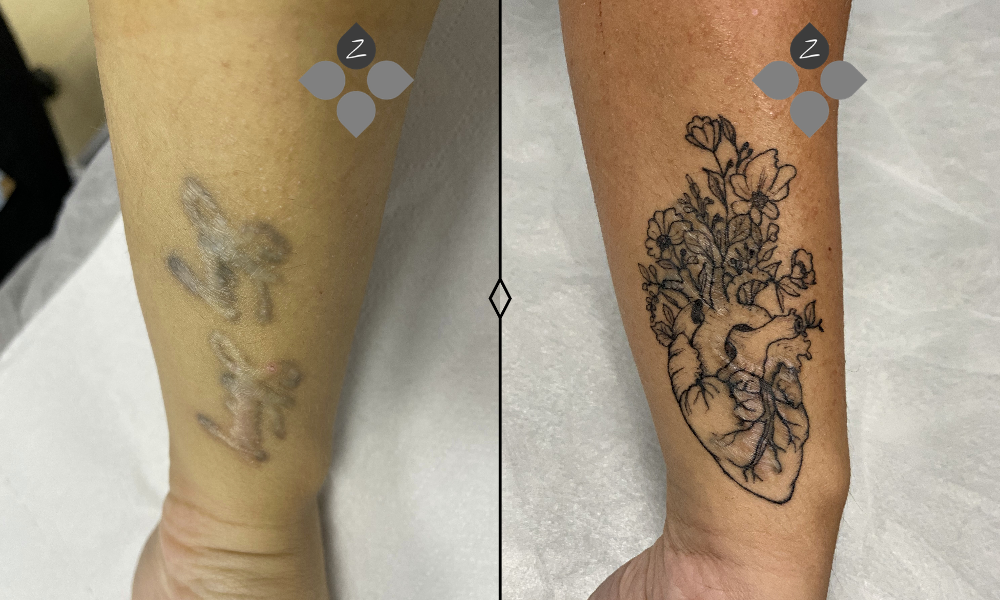 #micropigmentacion#micropigmentacionastuiras#micropigmentacioncapilar#micropigmentacioncejas#micropigmentacionlabios#tatuajereconstructivo#eliminaciondetatuajes