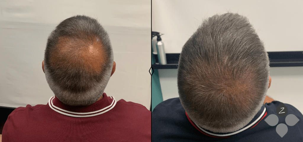 #micropigmentacion#micropigmentacionastuiras#micropigmentacioncapilar#micropigmentacioncejas#micropigmentacionlabios#tatuajereconstructivo#eliminaciondetatuajes