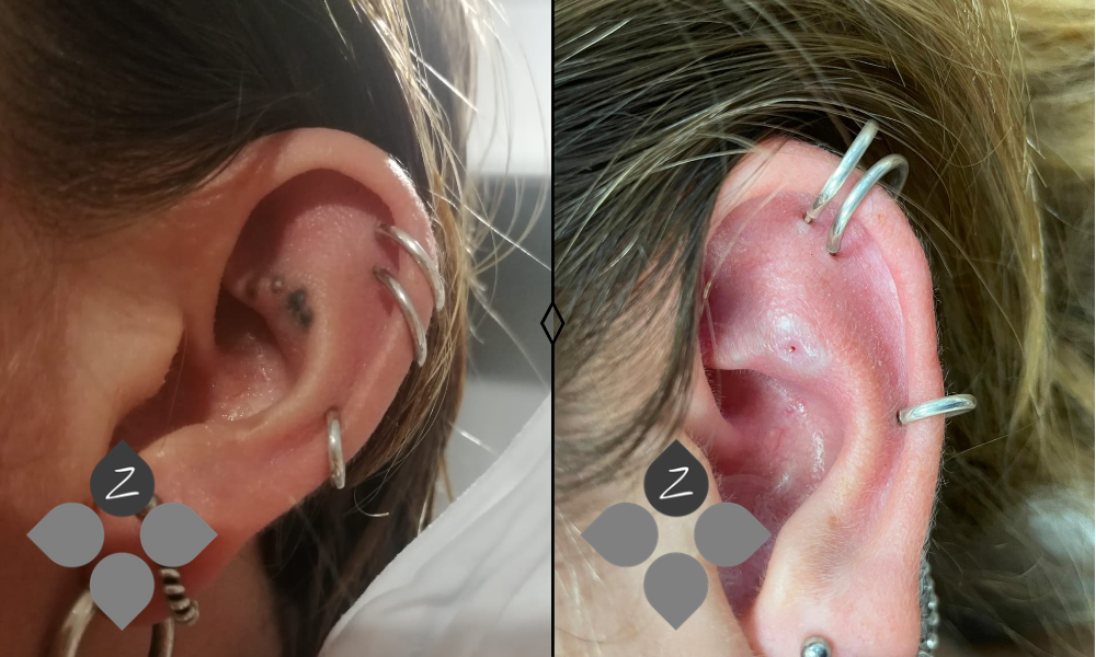 #micropigmentacion#micropigmentacionastuiras#micropigmentacioncapilar#micropigmentacioncejas#micropigmentacionlabios#tatuajereconstructivo#eliminaciondetatuajes