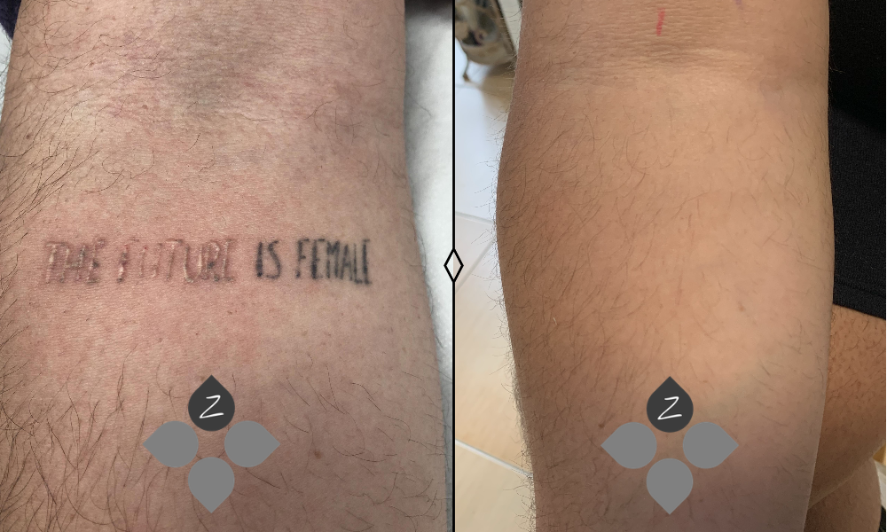 #micropigmentacion#micropigmentacionastuiras#micropigmentacioncapilar#micropigmentacioncejas#micropigmentacionlabios#tatuajereconstructivo#eliminaciondetatuajes