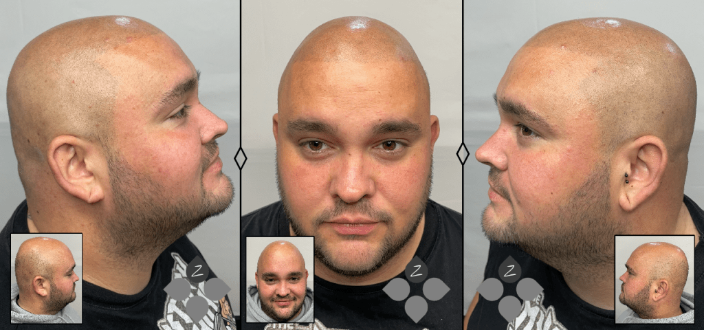 #micropigmentacion#micropigmentacionastuiras#micropigmentacioncapilar#micropigmentacioncejas#micropigmentacionlabios#tatuajereconstructivo#eliminaciondetatuajes