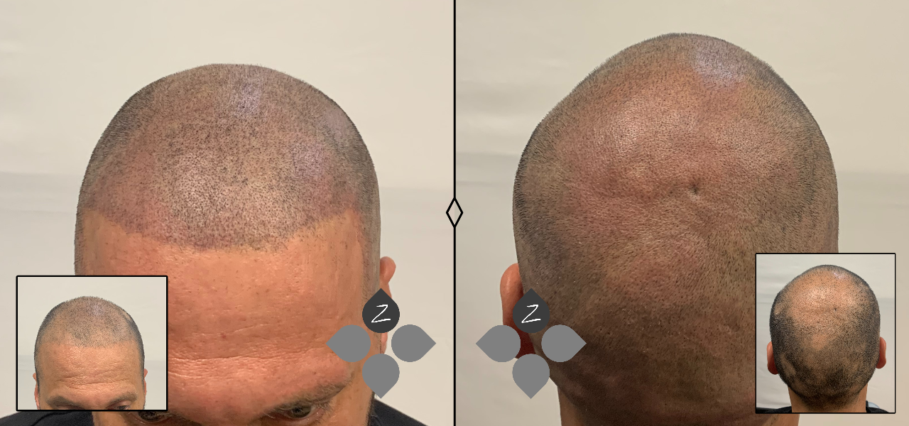 #micropigmentacion#micropigmentacionastuiras#micropigmentacioncapilar#micropigmentacioncejas#micropigmentacionlabios#tatuajereconstructivo#eliminaciondetatuajes