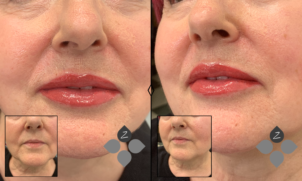 #micropigmentacion#micropigmentacionastuiras#micropigmentacioncapilar#micropigmentacioncejas#micropigmentacionlabios#tatuajereconstructivo#eliminaciondetatuajes