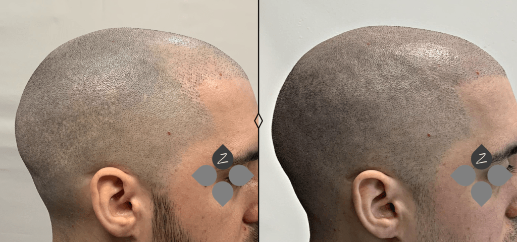 #micropigmentacion#micropigmentacionastuiras#micropigmentacioncapilar#micropigmentacioncejas#micropigmentacionlabios#tatuajereconstructivo#eliminaciondetatuajes