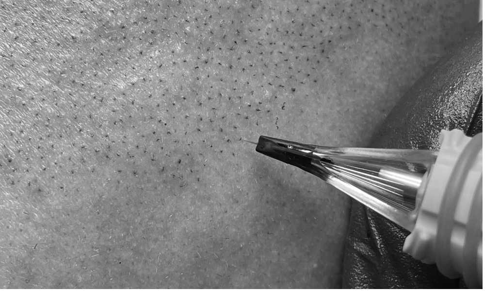 #micropigmentacion#micropigmentacionastuiras#micropigmentacioncapilar#micropigmentacioncejas#micropigmentacionlabios#tatuajereconstructivo#eliminaciondetatuajes