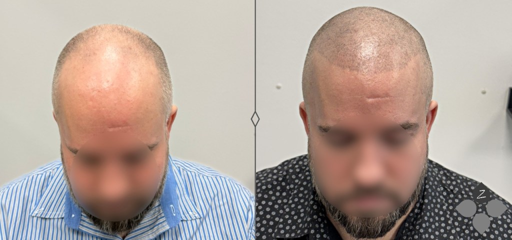 #micropigmentacion#micropigmentacionastuiras#micropigmentacioncapilar#micropigmentacioncejas#micropigmentacionlabios#tatuajereconstructivo#eliminaciondetatuajes