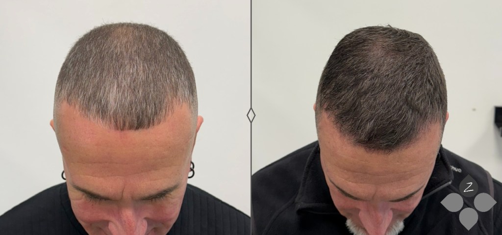 #micropigmentacion#micropigmentacionastuiras#micropigmentacioncapilar#micropigmentacioncejas#micropigmentacionlabios#tatuajereconstructivo#eliminaciondetatuajes