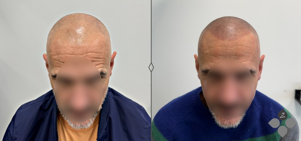 #micropigmentacion#micropigmentacionastuiras#micropigmentacioncapilar#micropigmentacioncejas#micropigmentacionlabios#tatuajereconstructivo#eliminaciondetatuajes