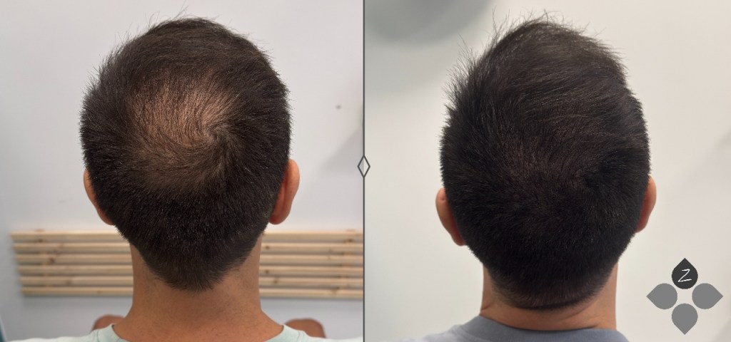 #micropigmentacion#micropigmentacionastuiras#micropigmentacioncapilar#micropigmentacioncejas#micropigmentacionlabios#tatuajereconstructivo#eliminaciondetatuajes